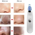 DermaSuction Vacuum Cleaning Device - TheLuxaryShop